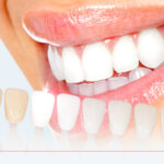 Effective Whitening Solutions Delivering Brighter Teeth Without Complex Dental Procedures